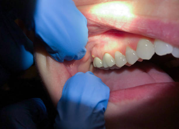 Best Broken or Cracked Tooth Emergency Dentist in Cambridge, MD
